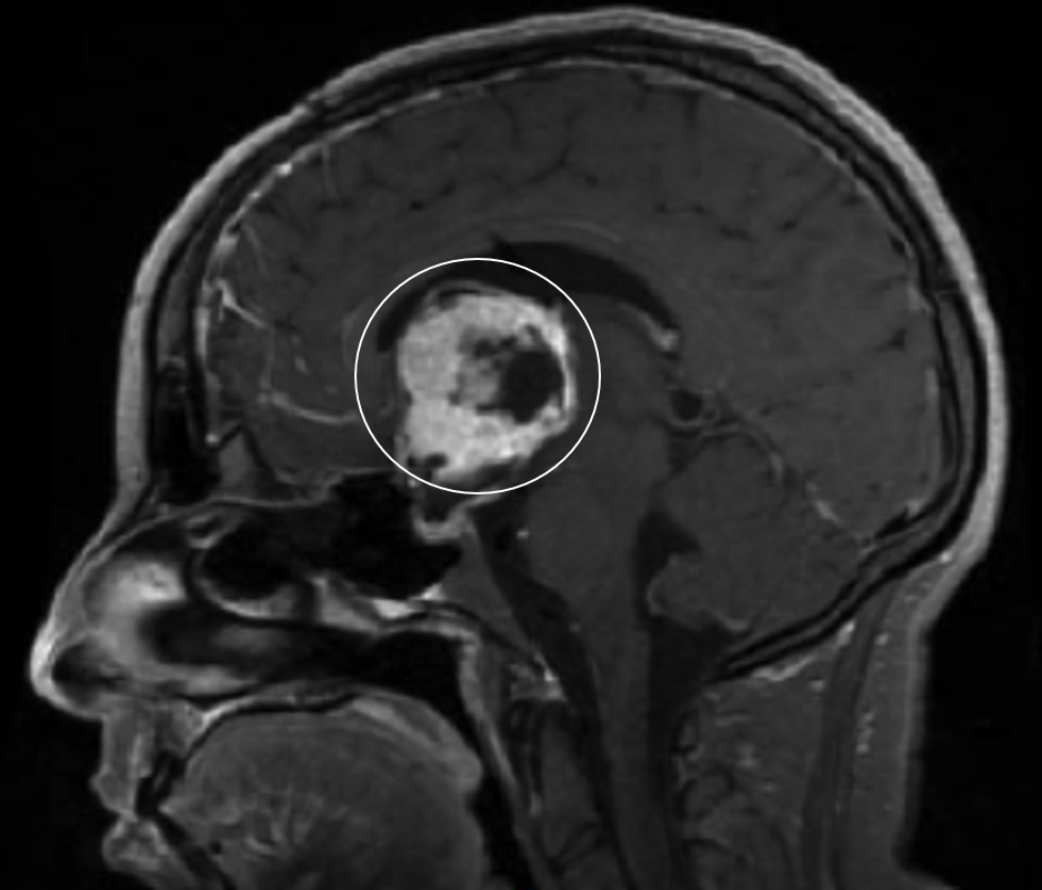 Le gliome chordoïde : un sous-type de tumeurs cérébrales encore ...